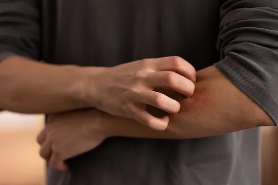 Persona rascándose el brazo por la piel irritada