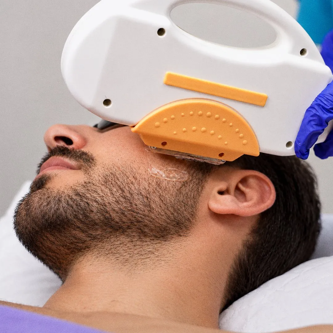 Cabezal del láser sobre la barba de un cliente con gafas de protección